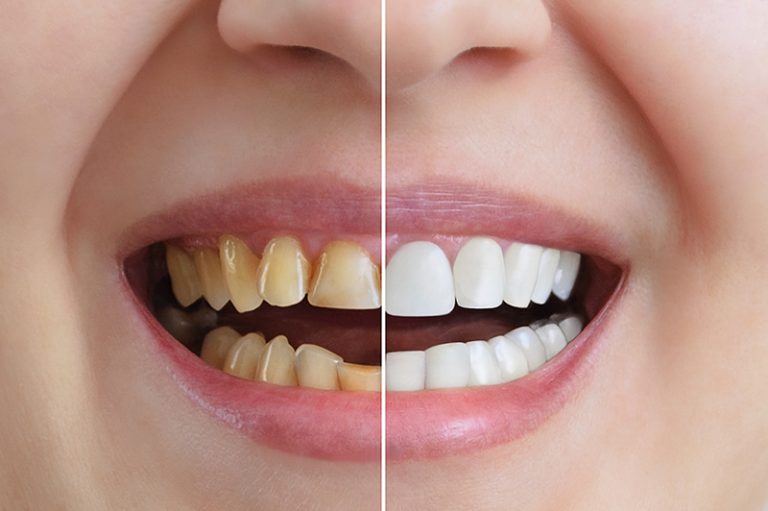Benestar Odontologia | Dentes amarelados, como prevenir e como clarear?