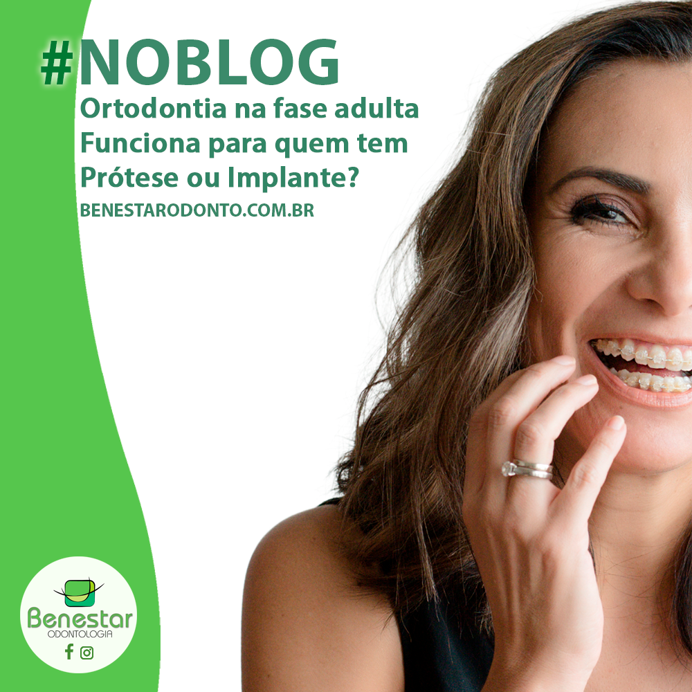 Ortodontia na fase adulta: Funciona para quem tem Prótese ou Implante?
